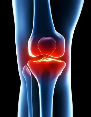 desgaste-de-rodilla Reemplazo total de rodilla en Benito Juárez