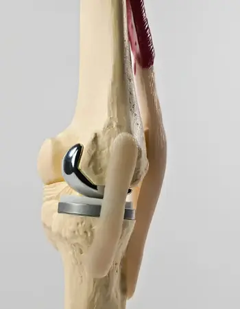 protesis-de-rodilla Reemplazo total de rodilla en Benito Juárez
